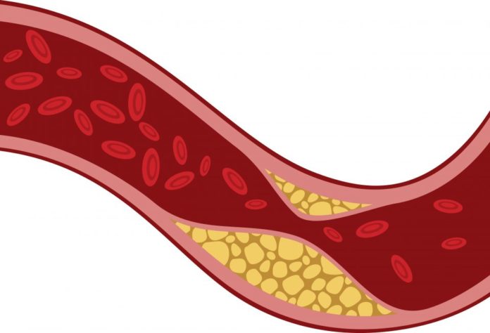 Higher Fibroatheroma Prevalence, Lower Healed Plaques Seen in Those with Recurrent ACS